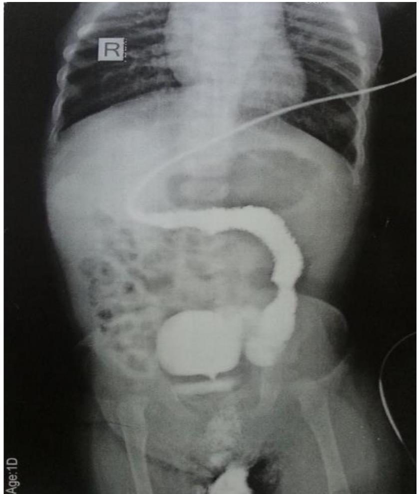 (PDF) H-type Rectourethral Fistula with Anal Stenosis in a Male Patient ...