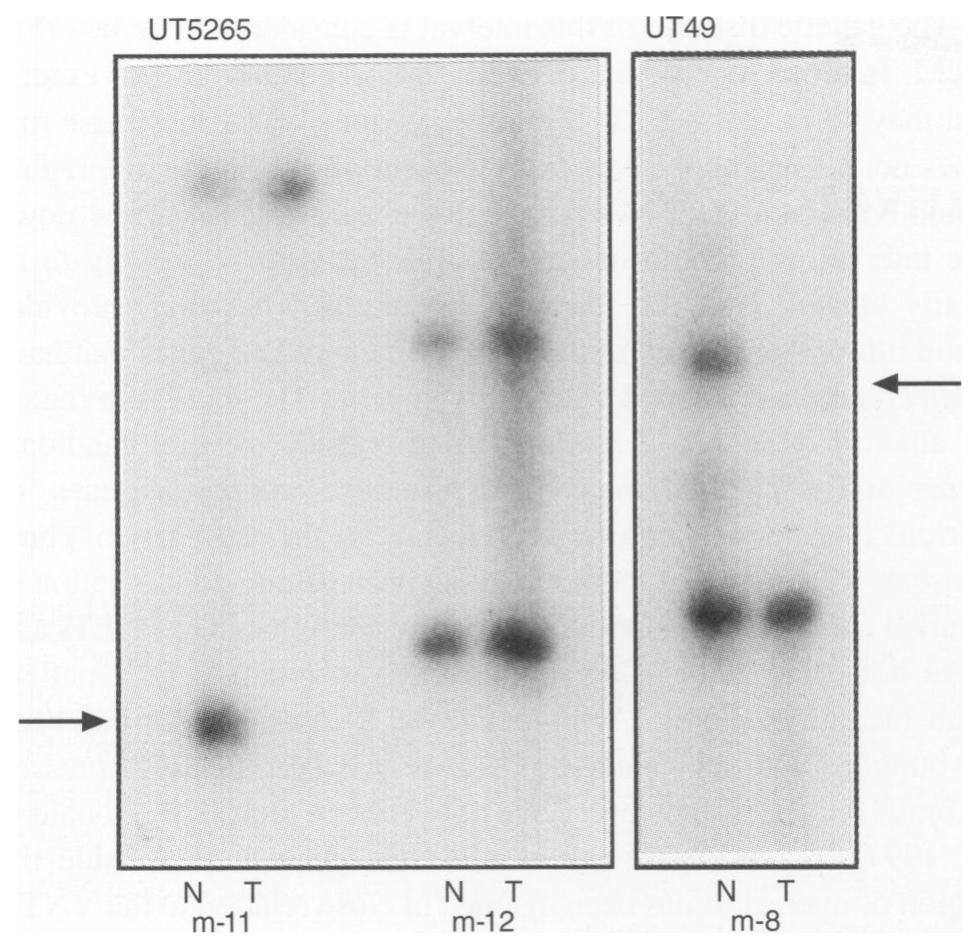 Figure 1 Example of detection of loss of heterozygosity. LOH was analysed by comparing normal (blood) DNA (N) with tumour DNA (T). Patients m-11 and m-8 demonstrate LOH with marker UT5265 and UT49 respectively; patient m-12 retained both alleles in the tumour 