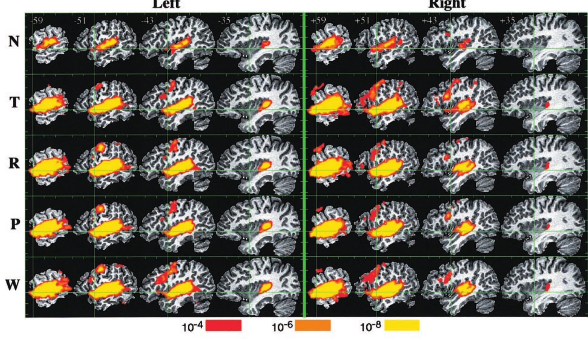 (PDF) Human Temporal Lobe Activation by Speech and Nonspeech Sounds