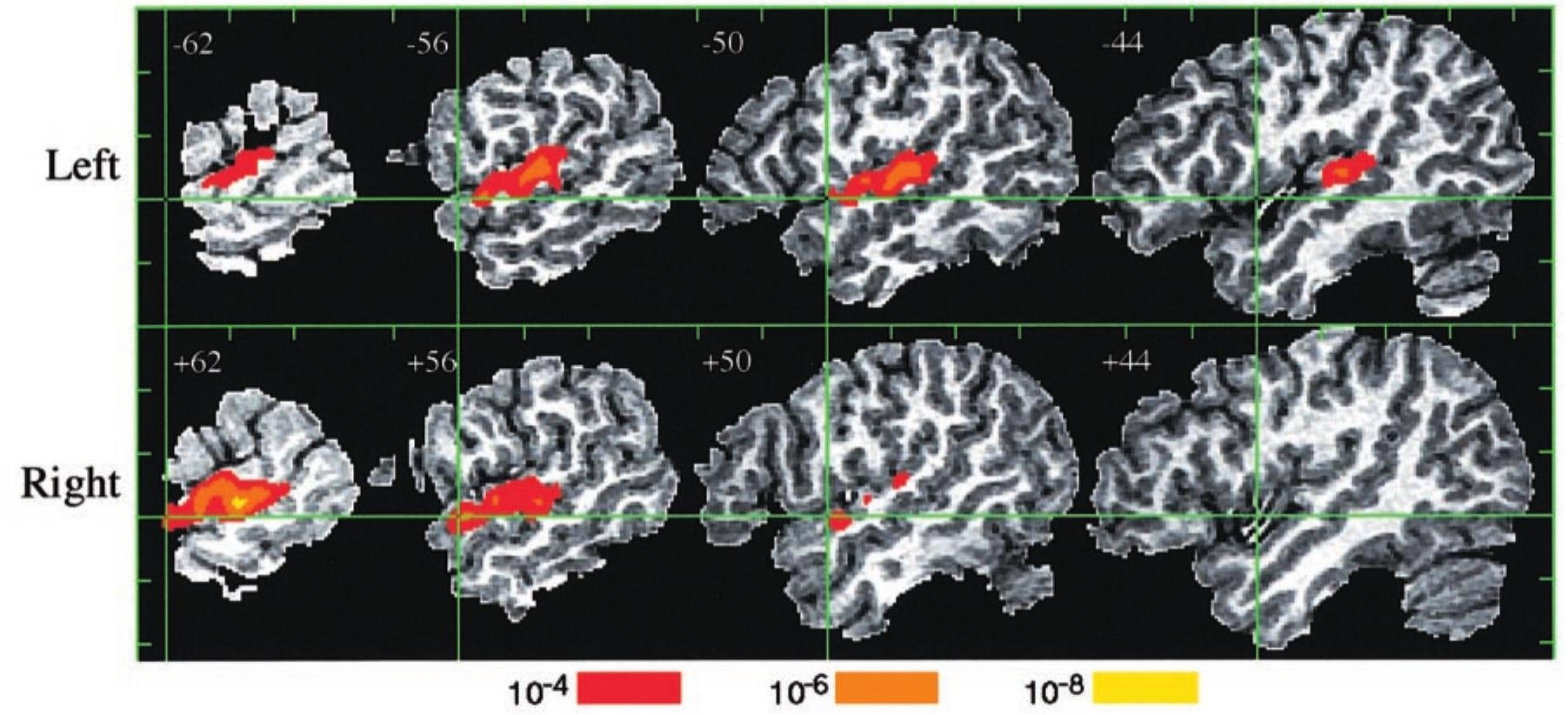 (PDF) Human Temporal Lobe Activation by Speech and Nonspeech Sounds
