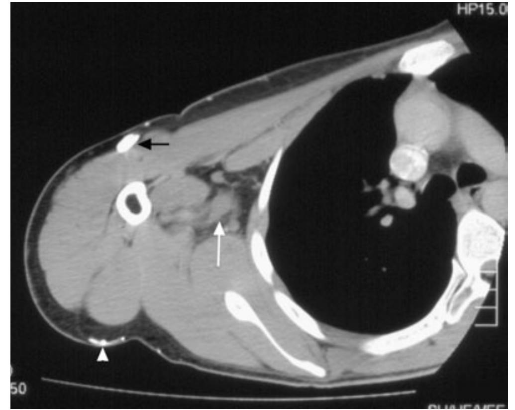 Axillary Scan
