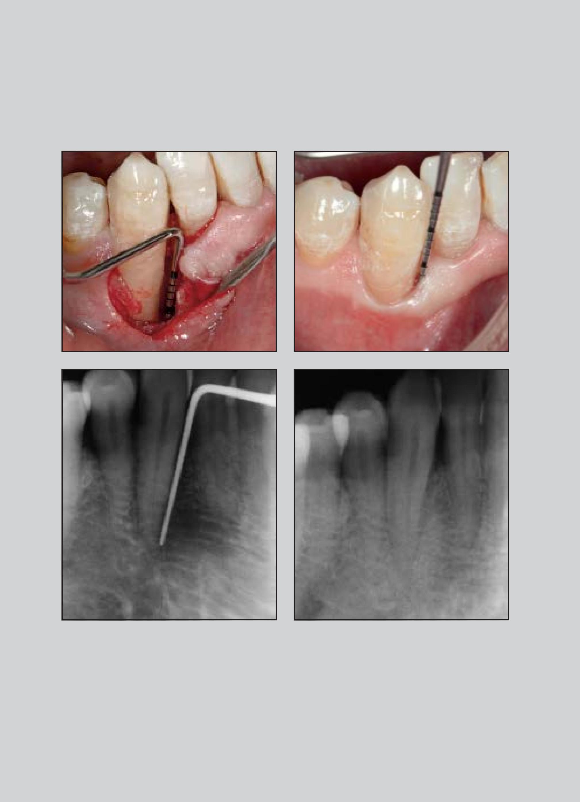 PDF) Entire Papilla Preservation Technique: A Novel Surgical