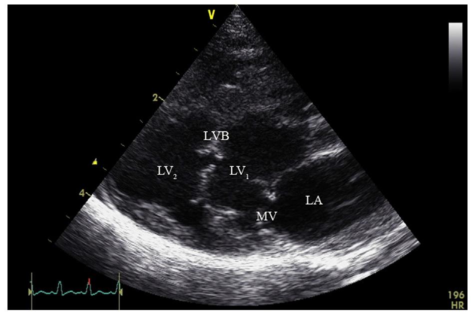 Figure 1 - from Double-chambered left ventricle in a cat