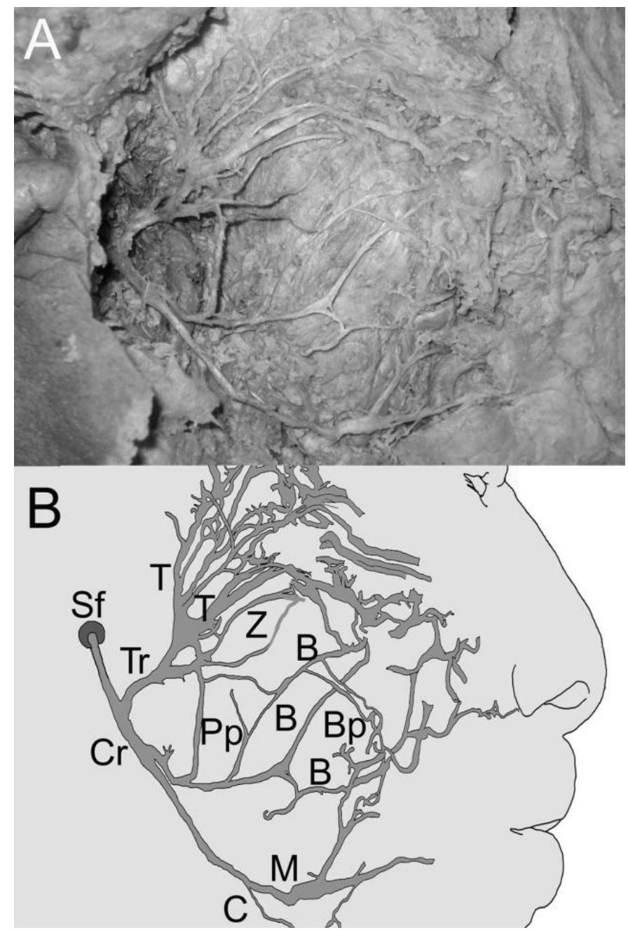 Marginal Ramus (PDF) Topographic anatomy of the peripheral branches of the facial nerve