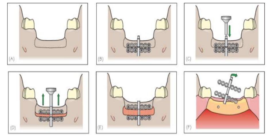 (PDF) Distraction Osteogenesis in Oral and Maxillofacial Reconstruction ...