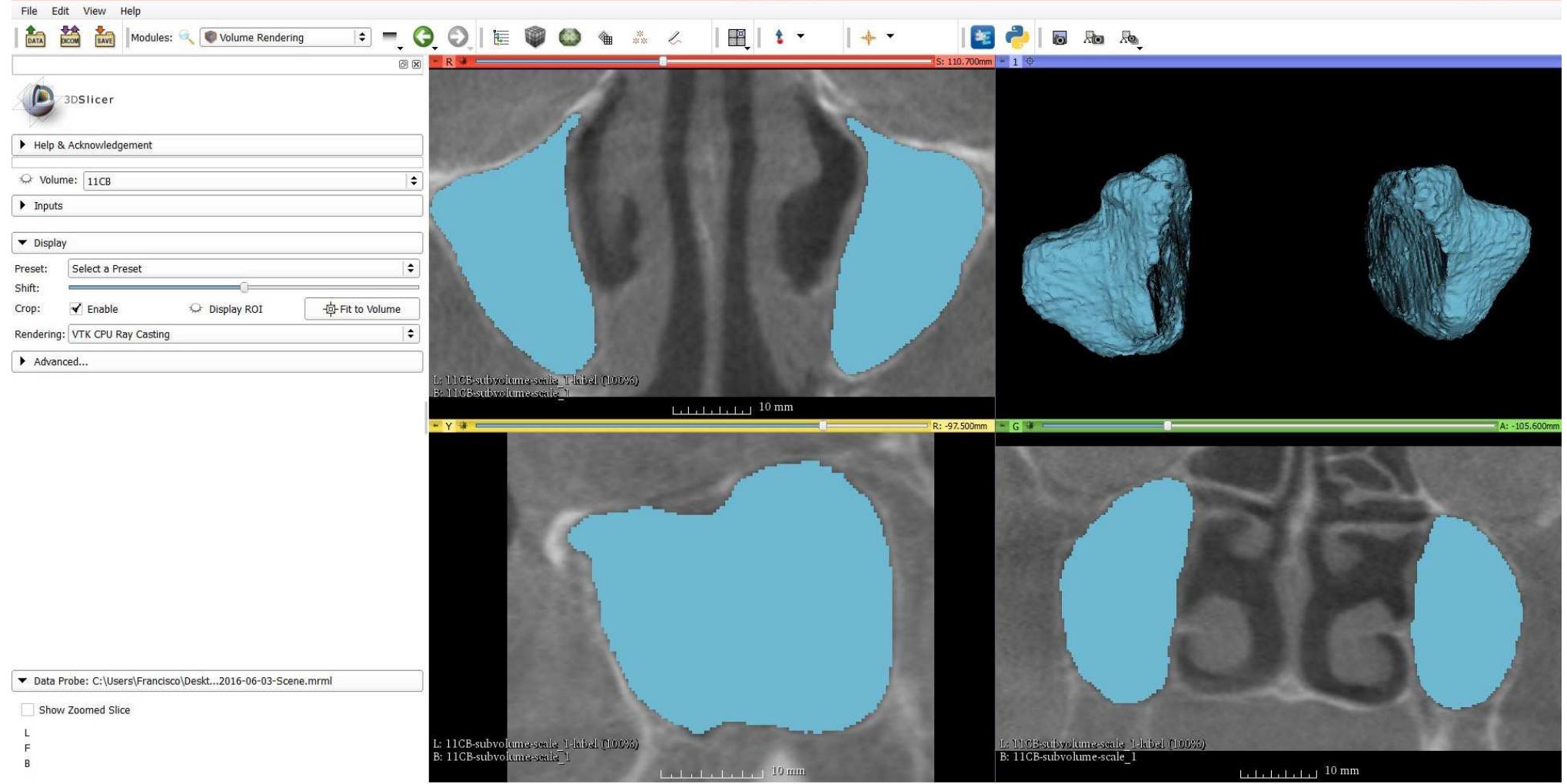(PDF) 3D Print of the Maxillary Sinus for Morphological Study
