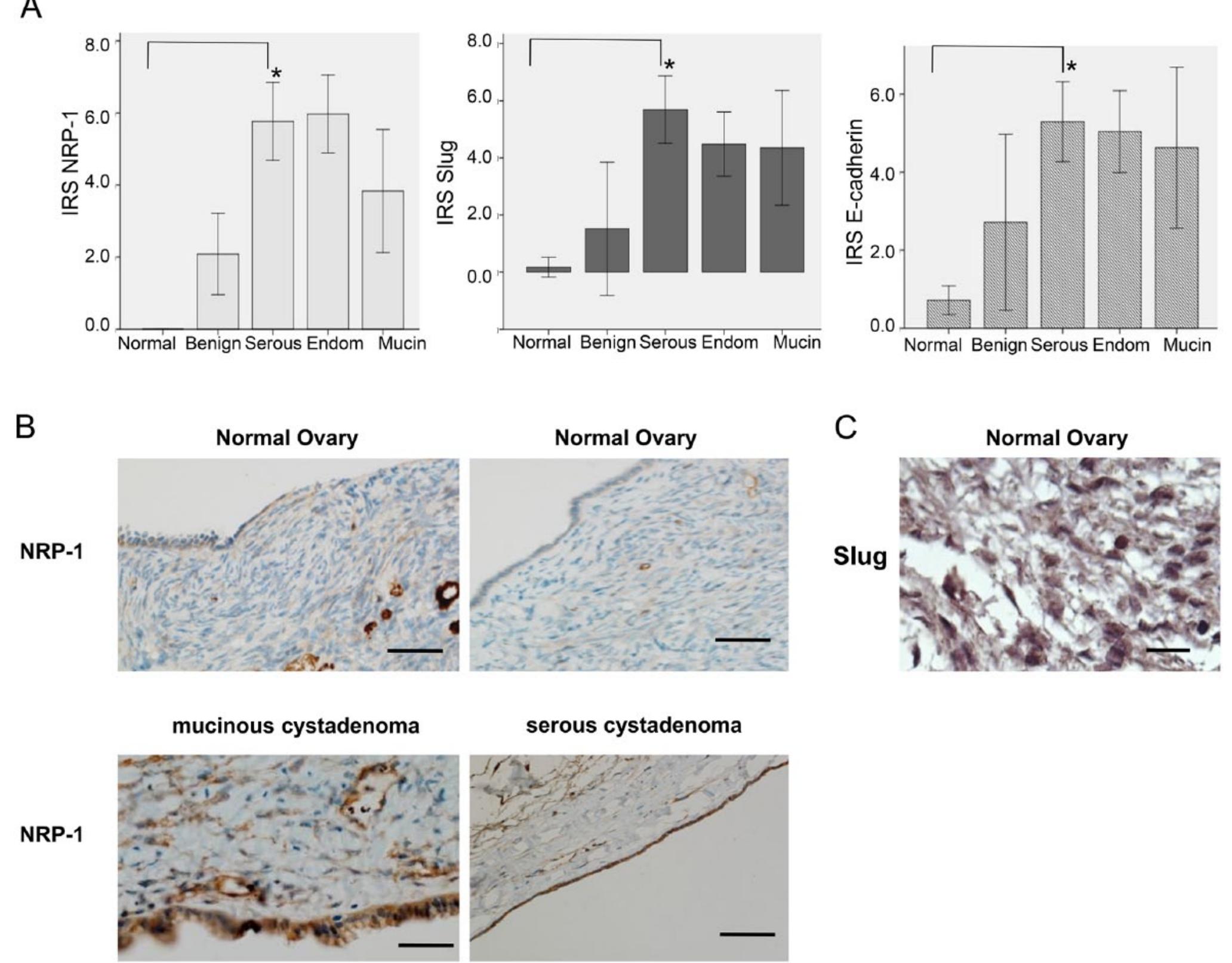 |. biomarker expression in normal, benign and malignant