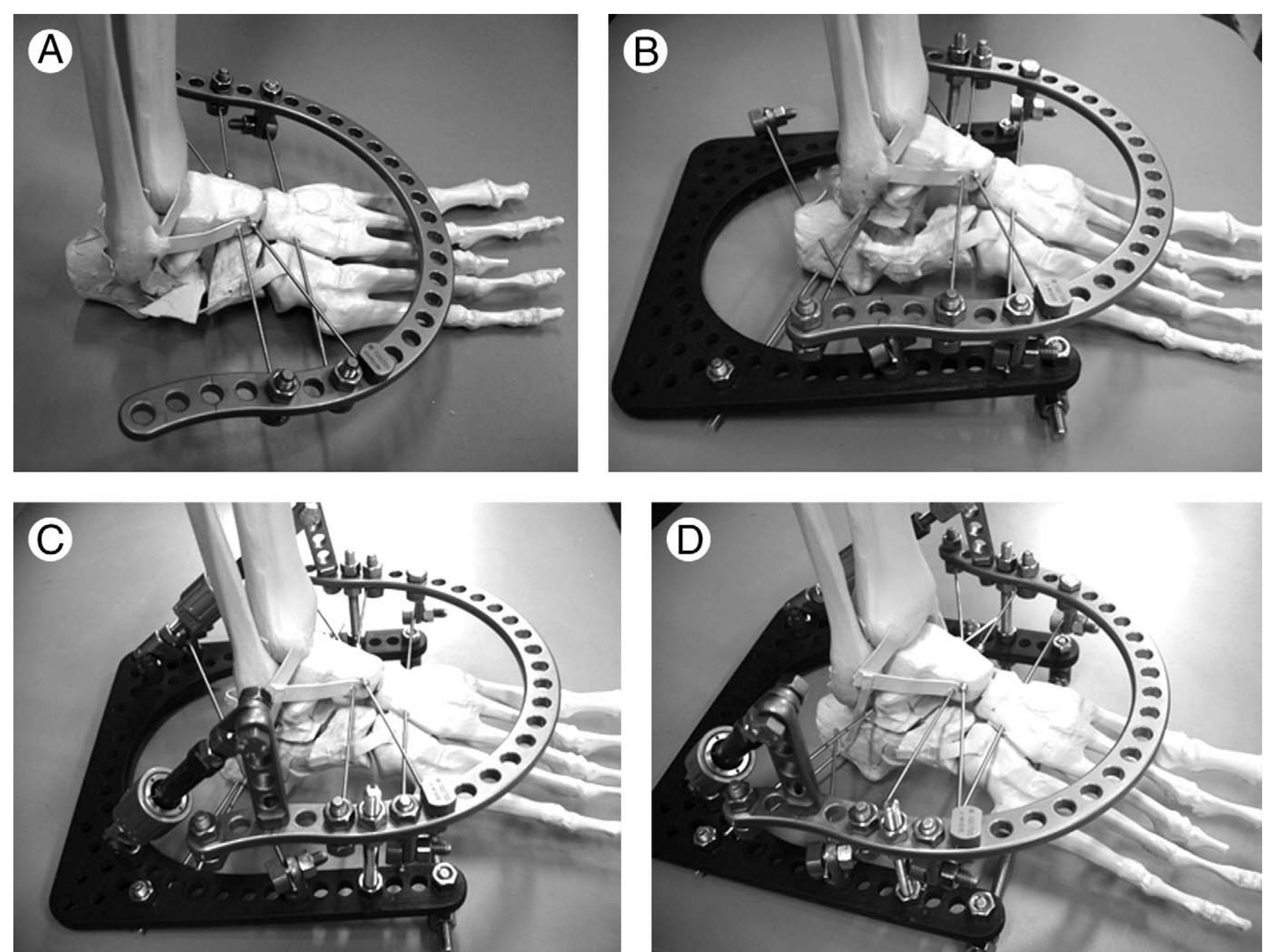 (PDF) The Below-the-Ankle Circular Frame: A New Technique for the ...