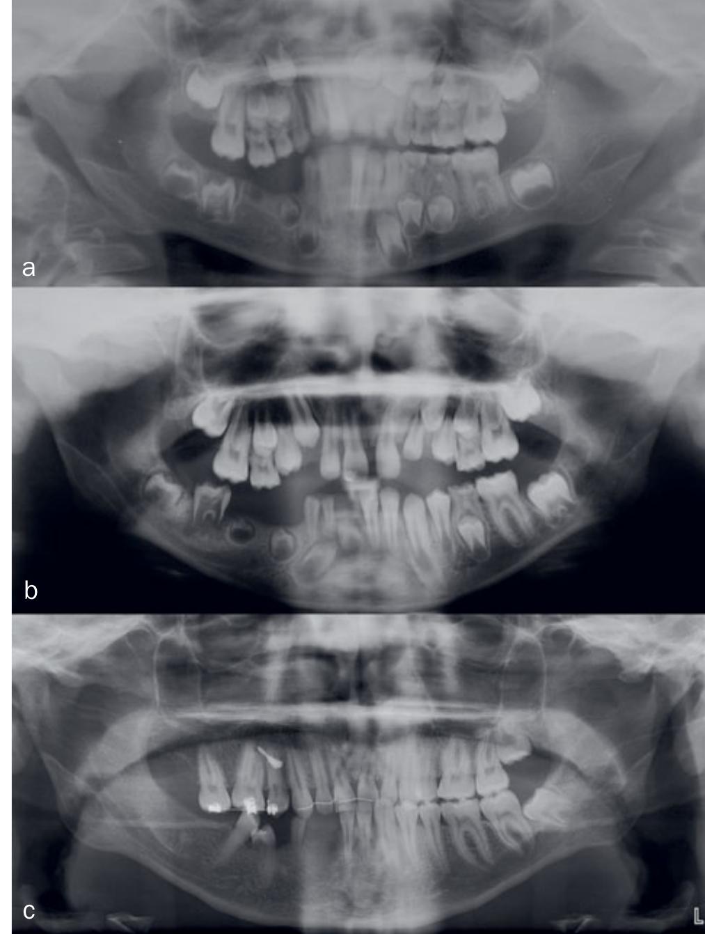 (PDF) Treatment Strategies for Patients with Regional Odontodysplasia ...