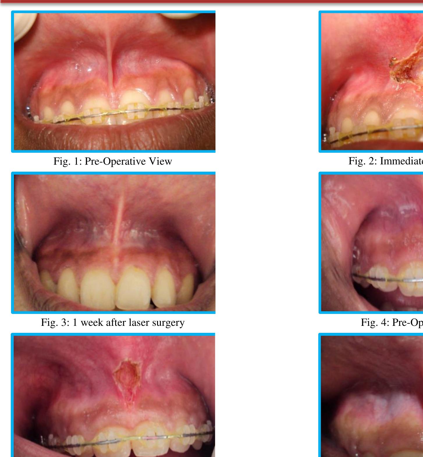 (PDF) Maxillary Labial Frenectomy Using Diode Laser-Report of Two Cases