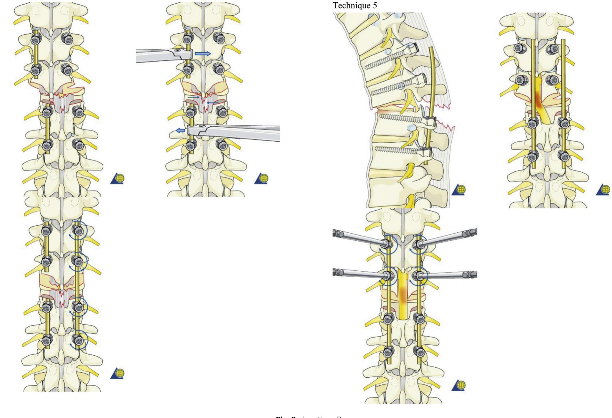 Figure 4 - Thoracolumbar fracture dislocation (AO type C