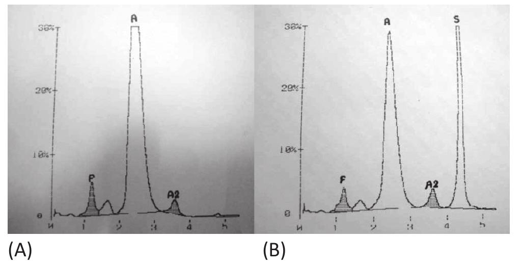 (PDF) Evaluation of (HPLC) Patterns of Sickle Cell Anaemia patients in ...