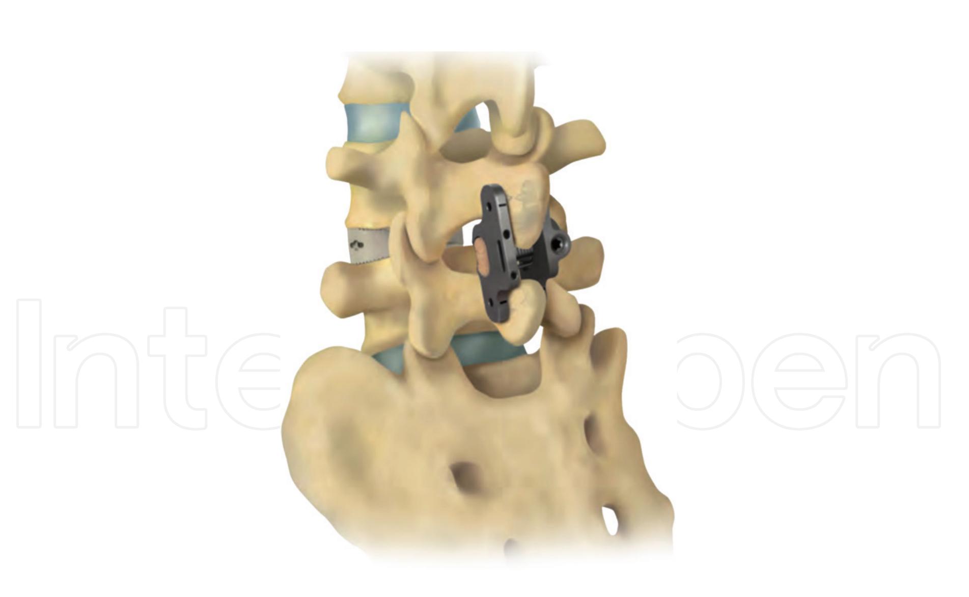 Figure 2 - from The Aspen MIS Spinous Process Fusion System