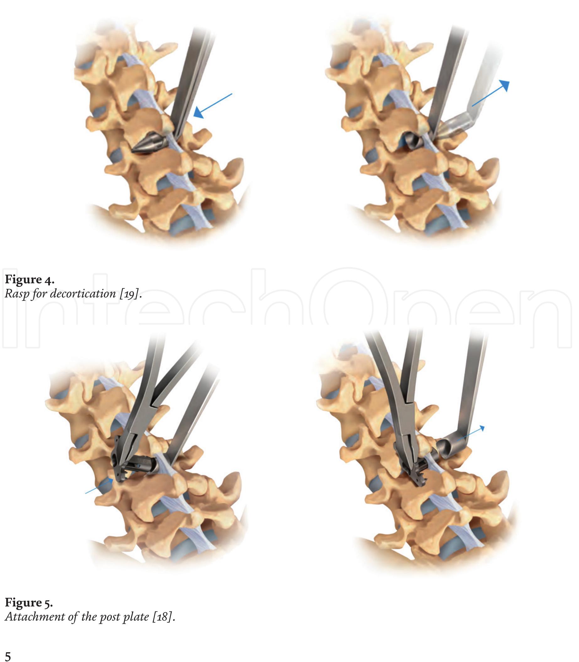 Figure 5 - from The Aspen MIS Spinous Process Fusion System
