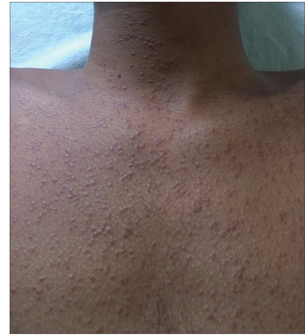 Stringo Mha Figure 2 - from Generalized eruptive syringoma: A clinical