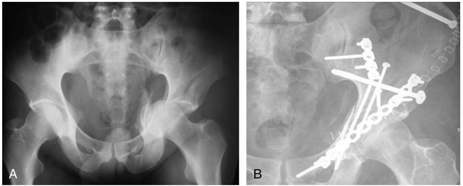 (PDF) Comparison of Acetabular Fracture Reduction Quality by the ...
