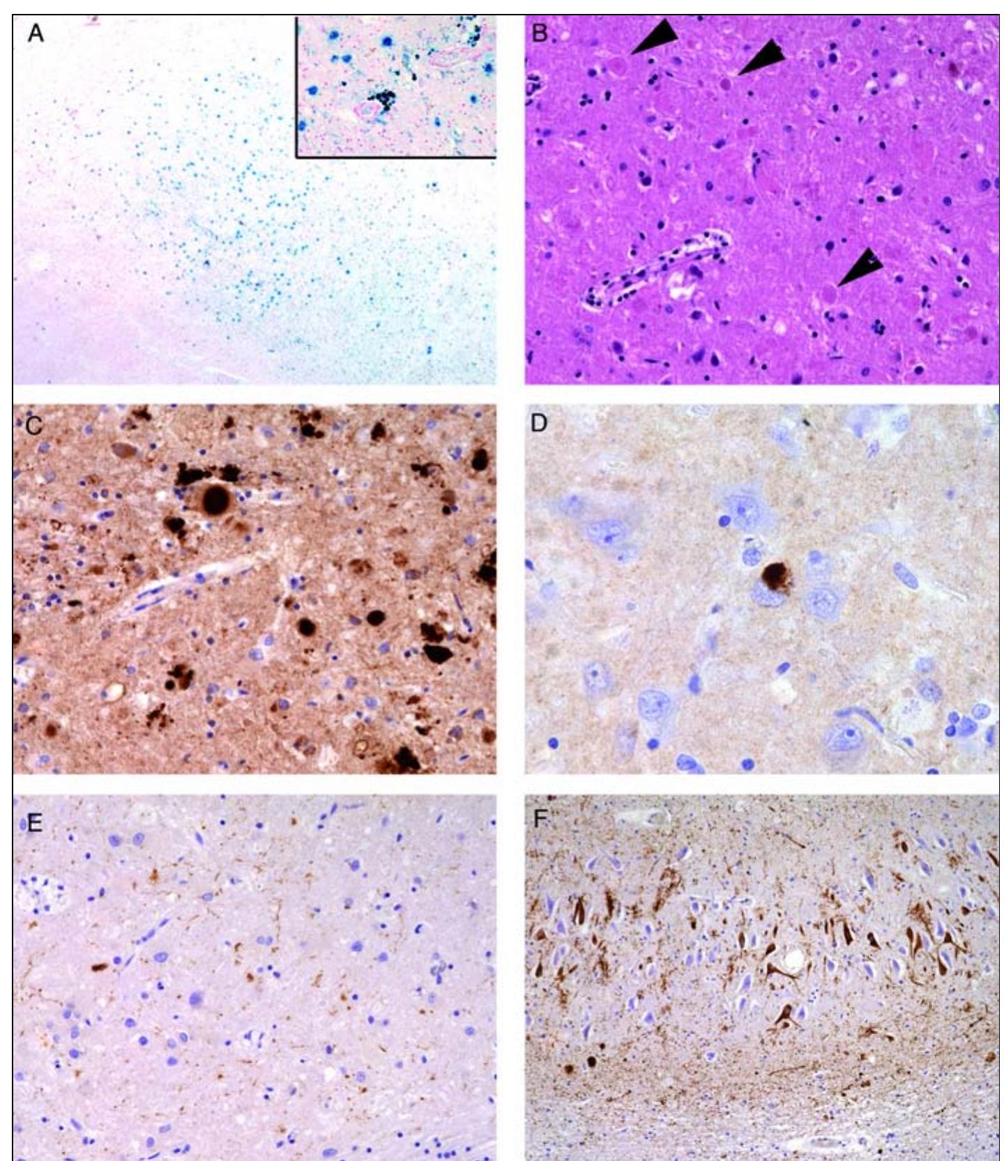 (PDF) Clinicopathological variability in neurodegeneration with brain ...