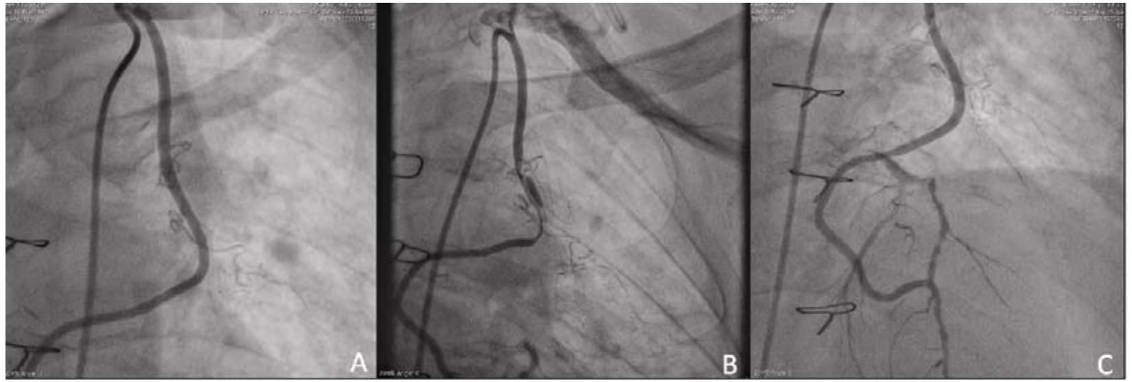 Lima Dissection (PDF) Unstable angina due to spontaneous left internal mammary artery ...