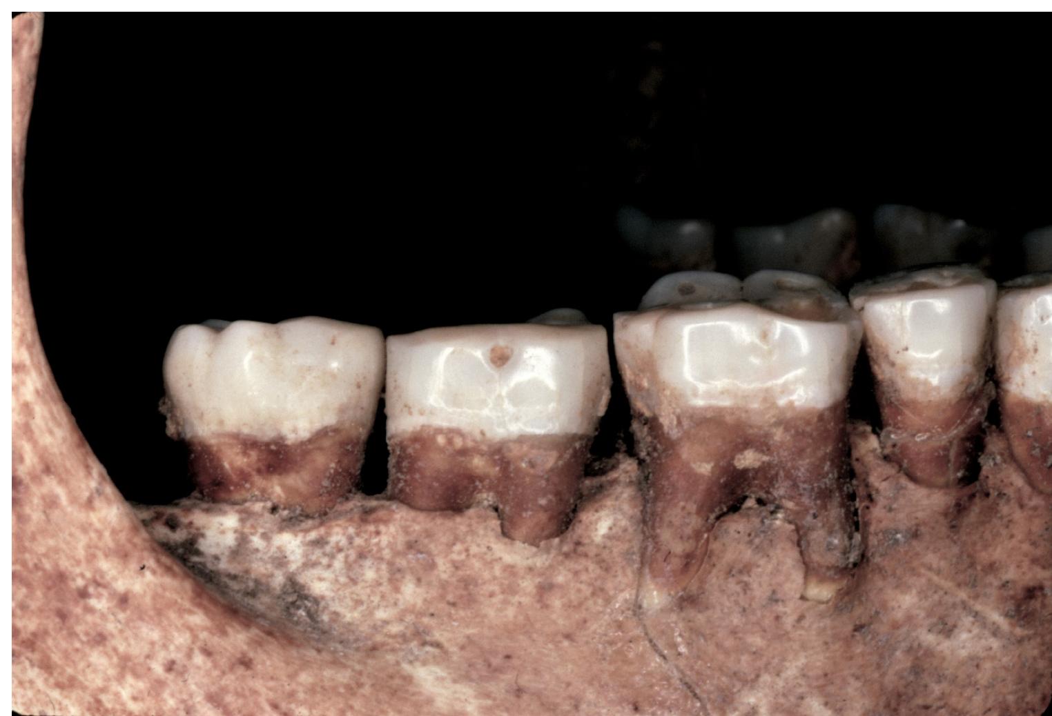 Figure 4. Close up of the right lateral mandibular component of an older adult Proto-Neolithic indi- vidual focusing on the buccal teeth and their gomphotic relations with the reseeding alveolar bone caused by periodontal disease; here to focus on the smooth and nearly horizontally homogeneous dental wear patterns reflective of the good quality of preparation of dietary intake, inclusive of grit as a biproduct of the milling tools made from quartzite in processing plant foods. 