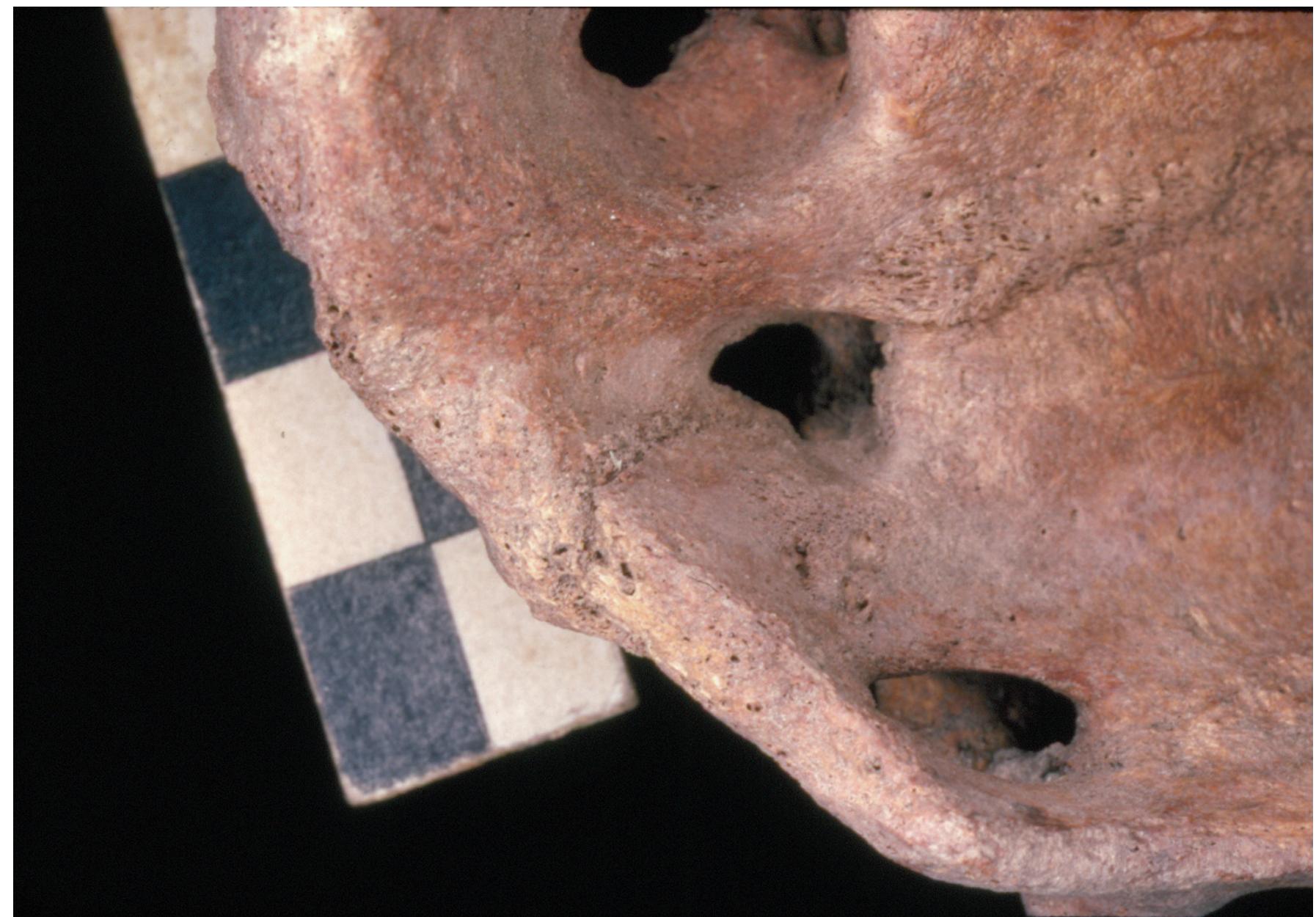 Figure 6. A close-up view of the lower right component of an os sacrum of an adult Proto-Neolithic individual showing a transversal fracture in a healed/very advanced stage of healing. 