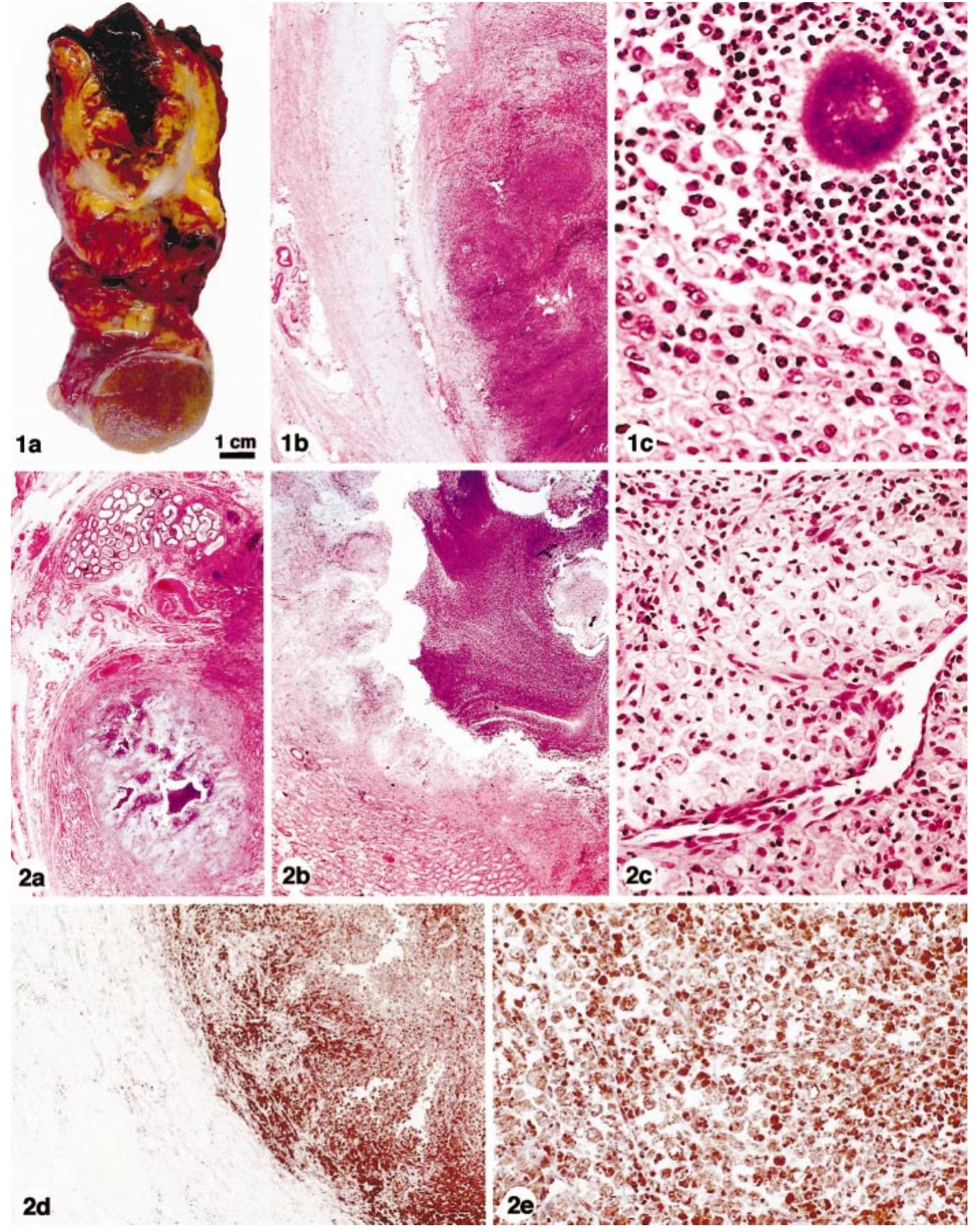 Funicularitis (PDF) Xanthogranulomatous funiculitis and orchiepididymitis: report of ...
