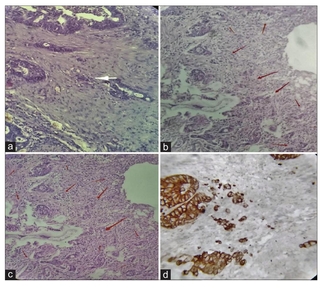 (PDF) Histopathological study of tumor budding in colorectal carcinoma ...