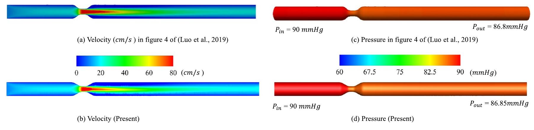 (PDF) Blood flow CFD simulation on a cerebral artery of a stroke patient