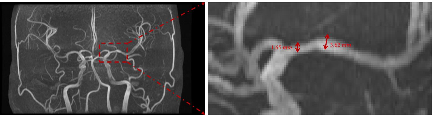(PDF) Blood flow CFD simulation on a cerebral artery of a stroke patient