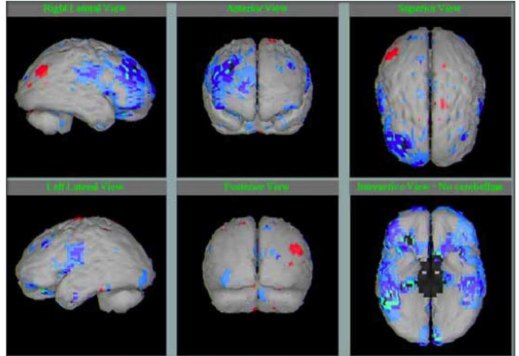 Typical me brain spect demonstrating diffuse brain