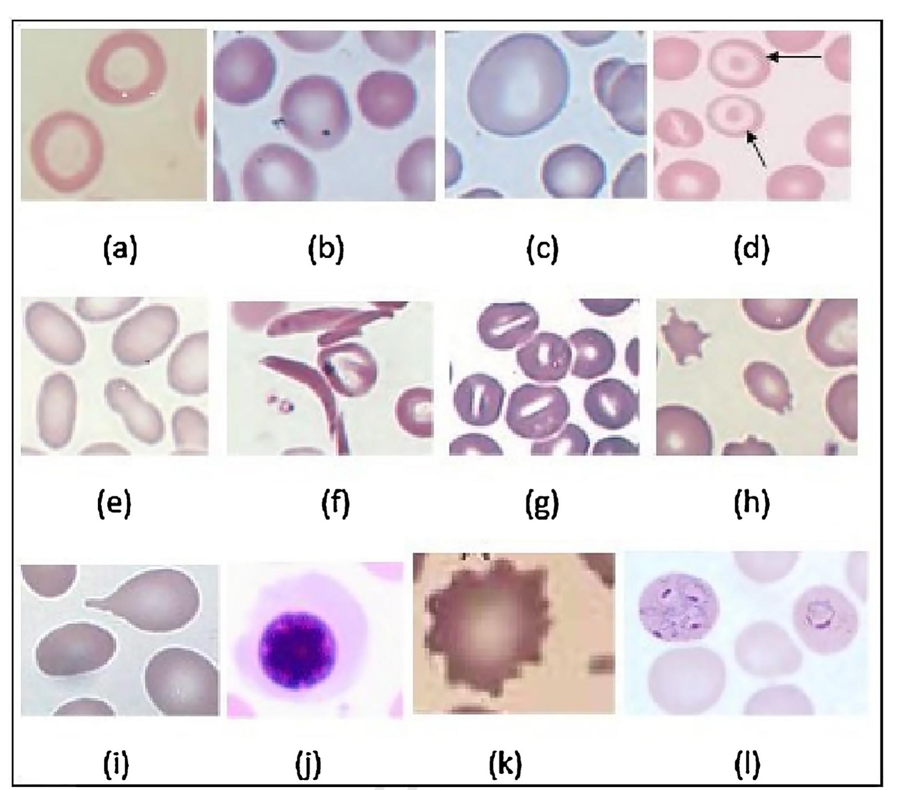 (PDF) Peripheral blood smear analysis using image processing approach ...