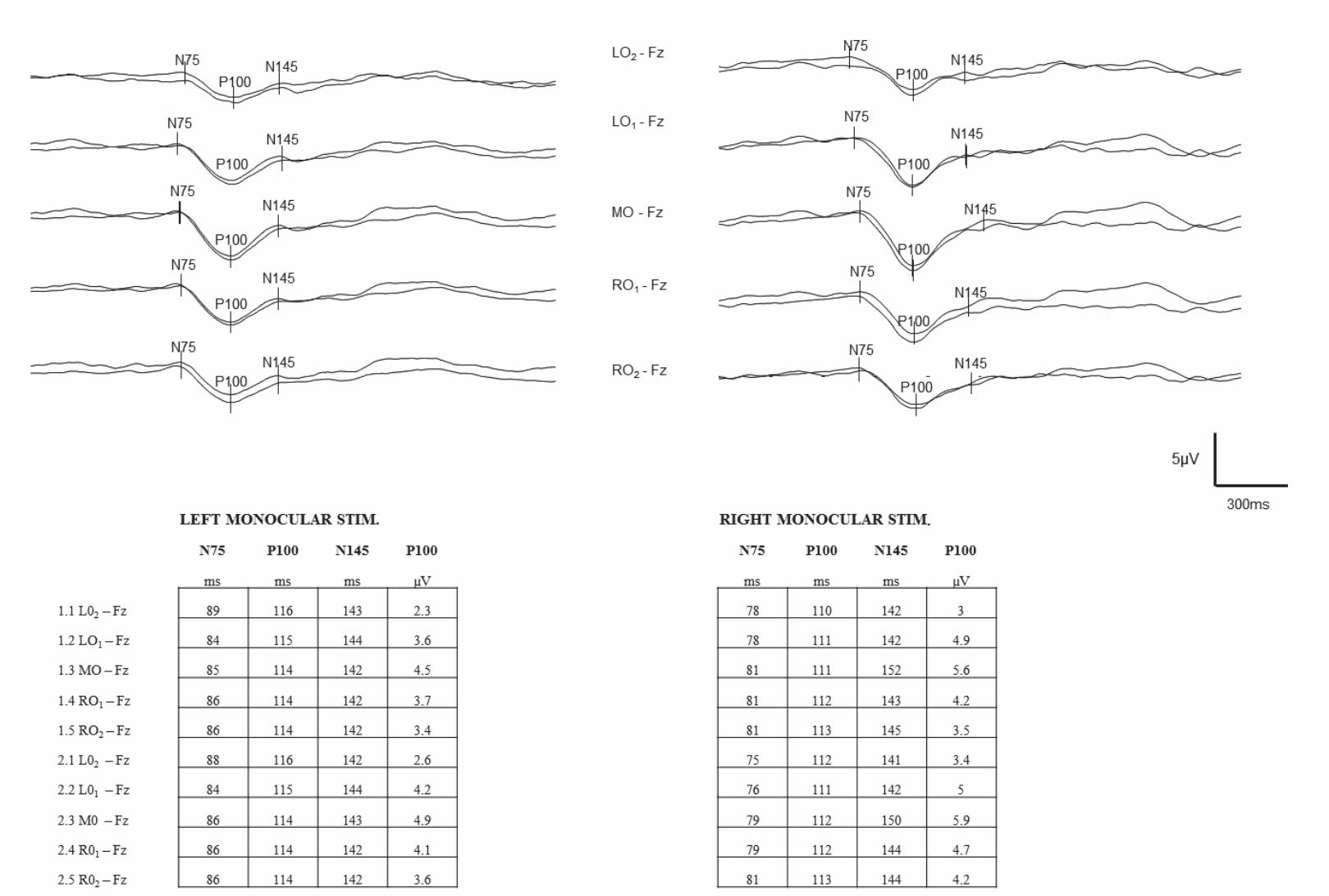 Figure 1 - from Visual evoked potentials - current concepts