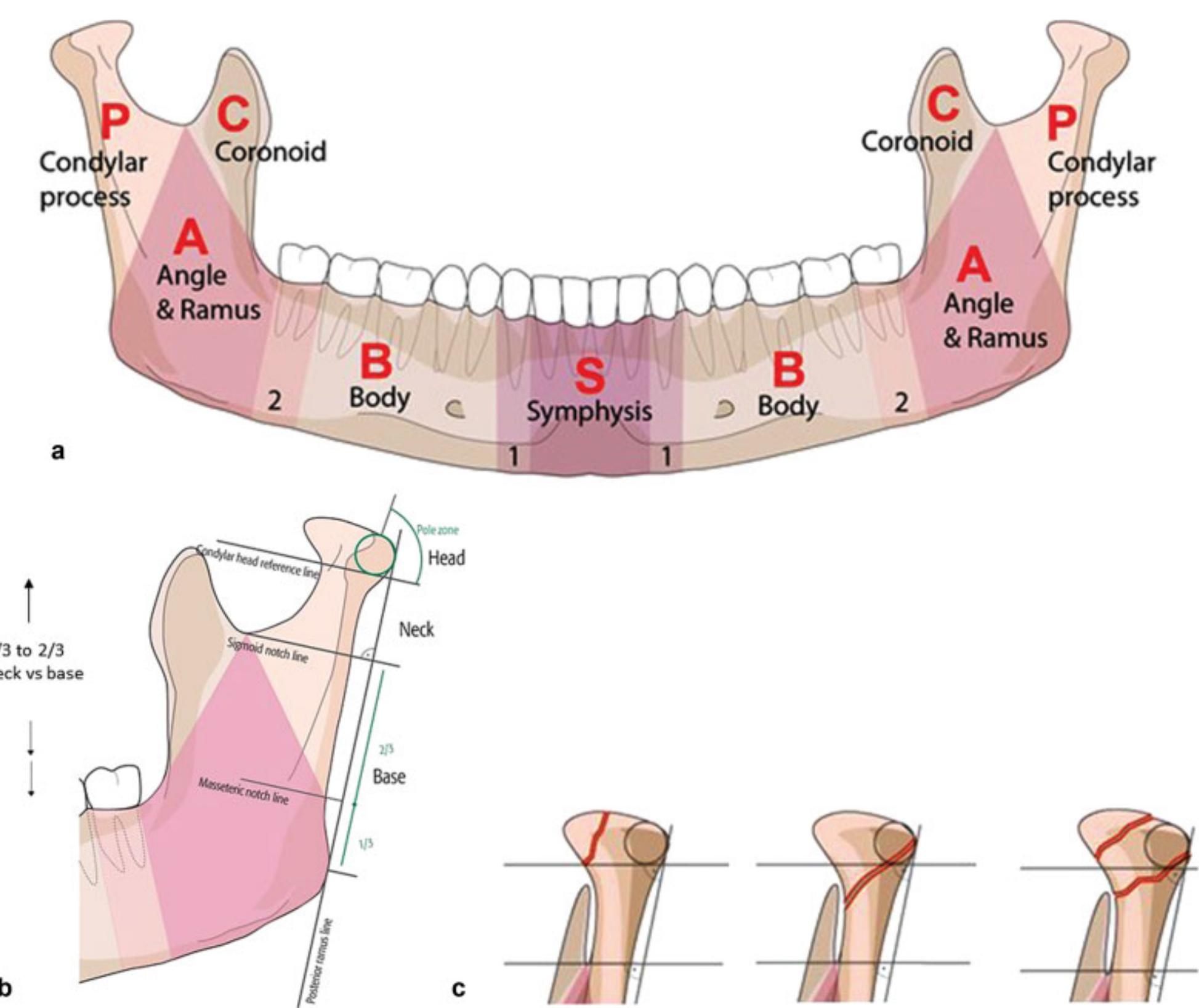 (PDF) The Comprehensive AO CMF Classification System for Mandibular ...