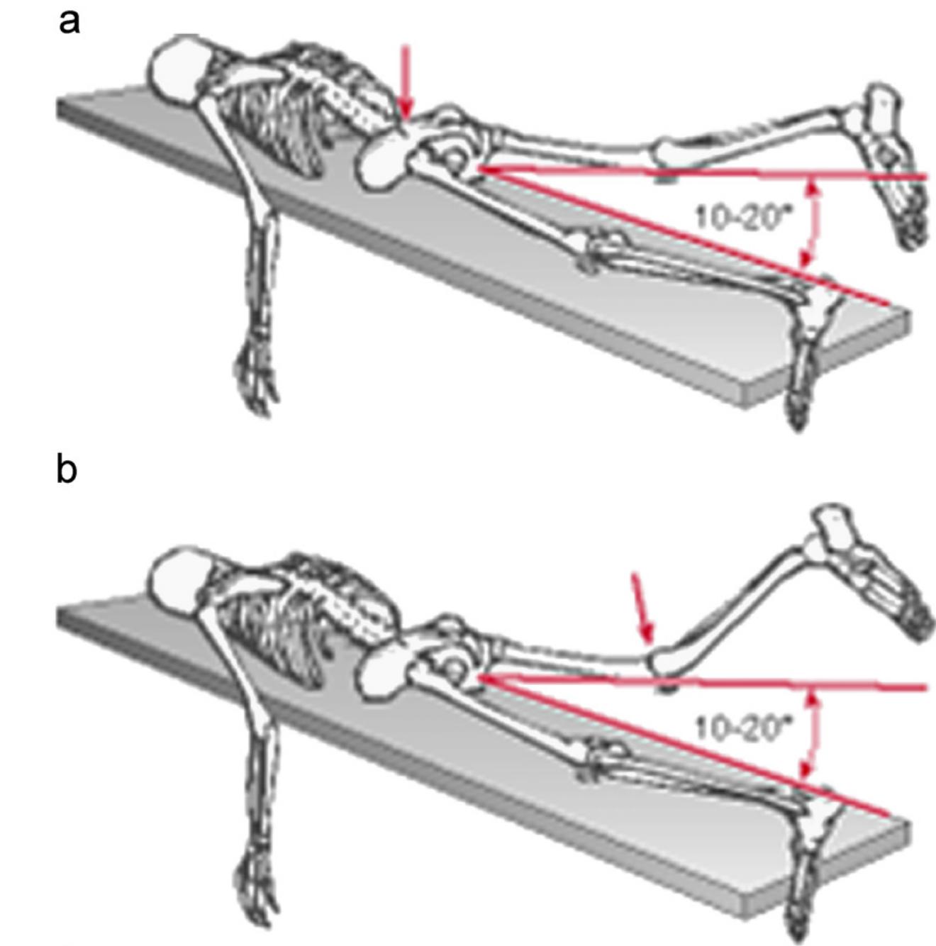 Hip Dysfunction (PDF) Hip dysfunction and back pain