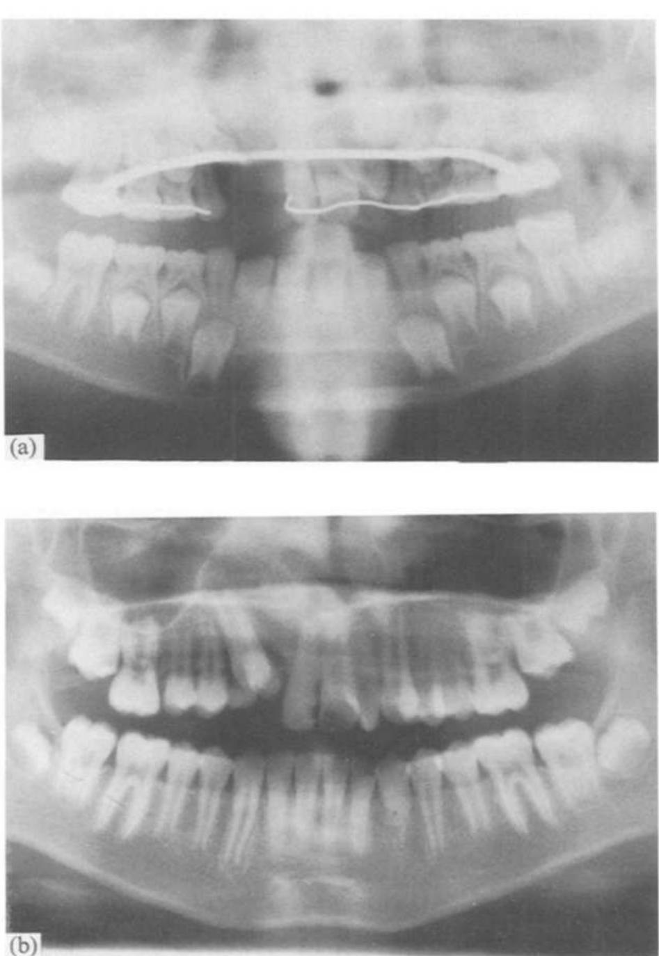 bone ingrowth into the donor defect in a 9.4 year old boy.