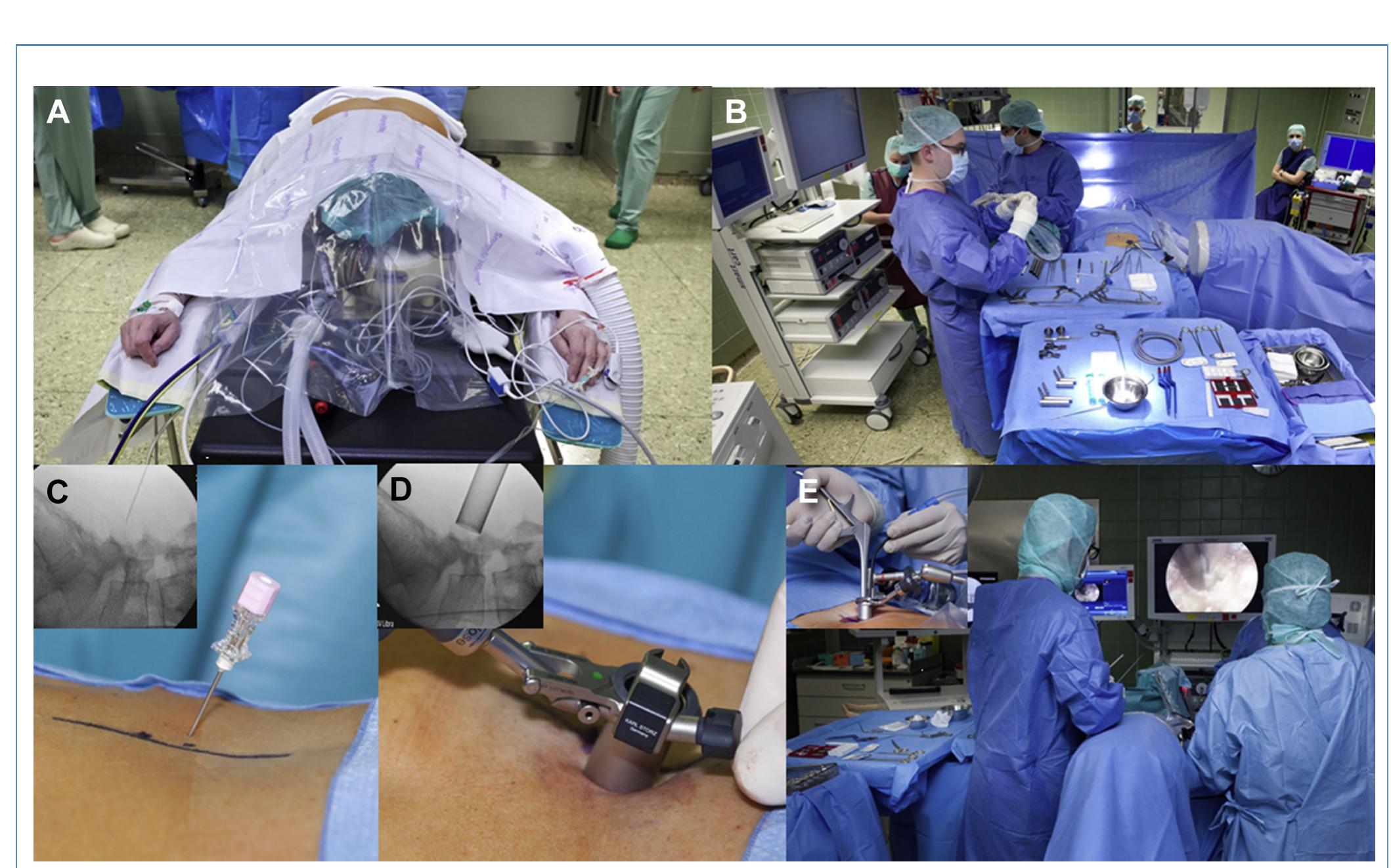 (PDF) The Learning Process of Endoscopic Spinal Surgery for ...