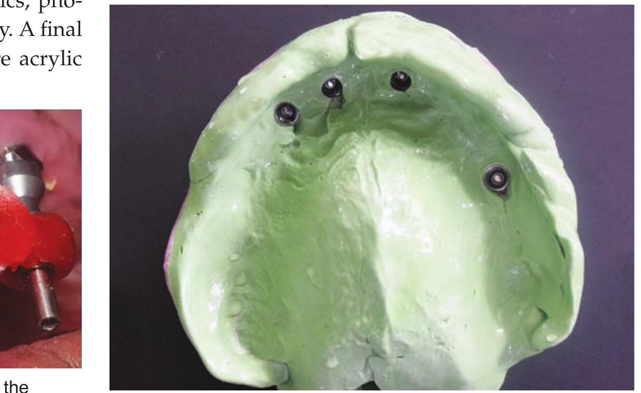 (PDF) Rehabilitation of a Patient with Completely Edentulous Maxillary ...
