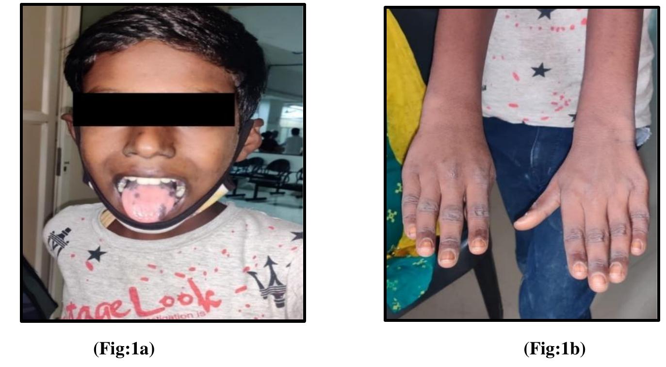 Figure 1 - from Addisonian Hyperpigmentation as Oral
