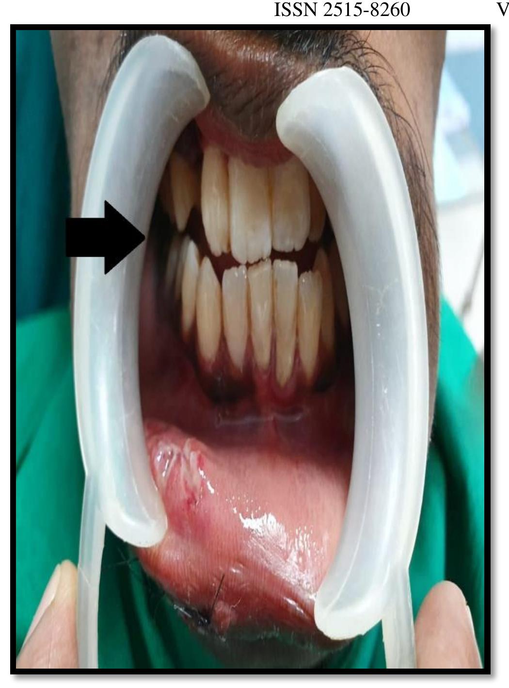 Figure 3 - Coleman Sign: A Hallmark For Mandibular Fracture?