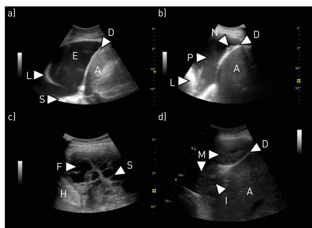 igure 2 pleural effusion and pleural malignancy. a) simple