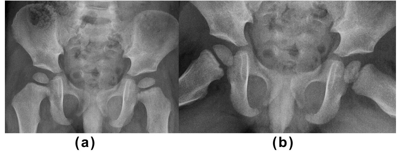 Figure 12 - from Radiological approach to a child with hip