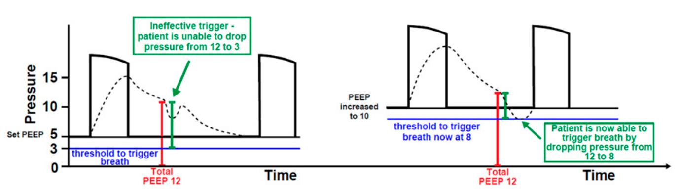 Peep Test Timer (PDF) How I Teach Auto-PEEP: Applying the Physiology of Expiration