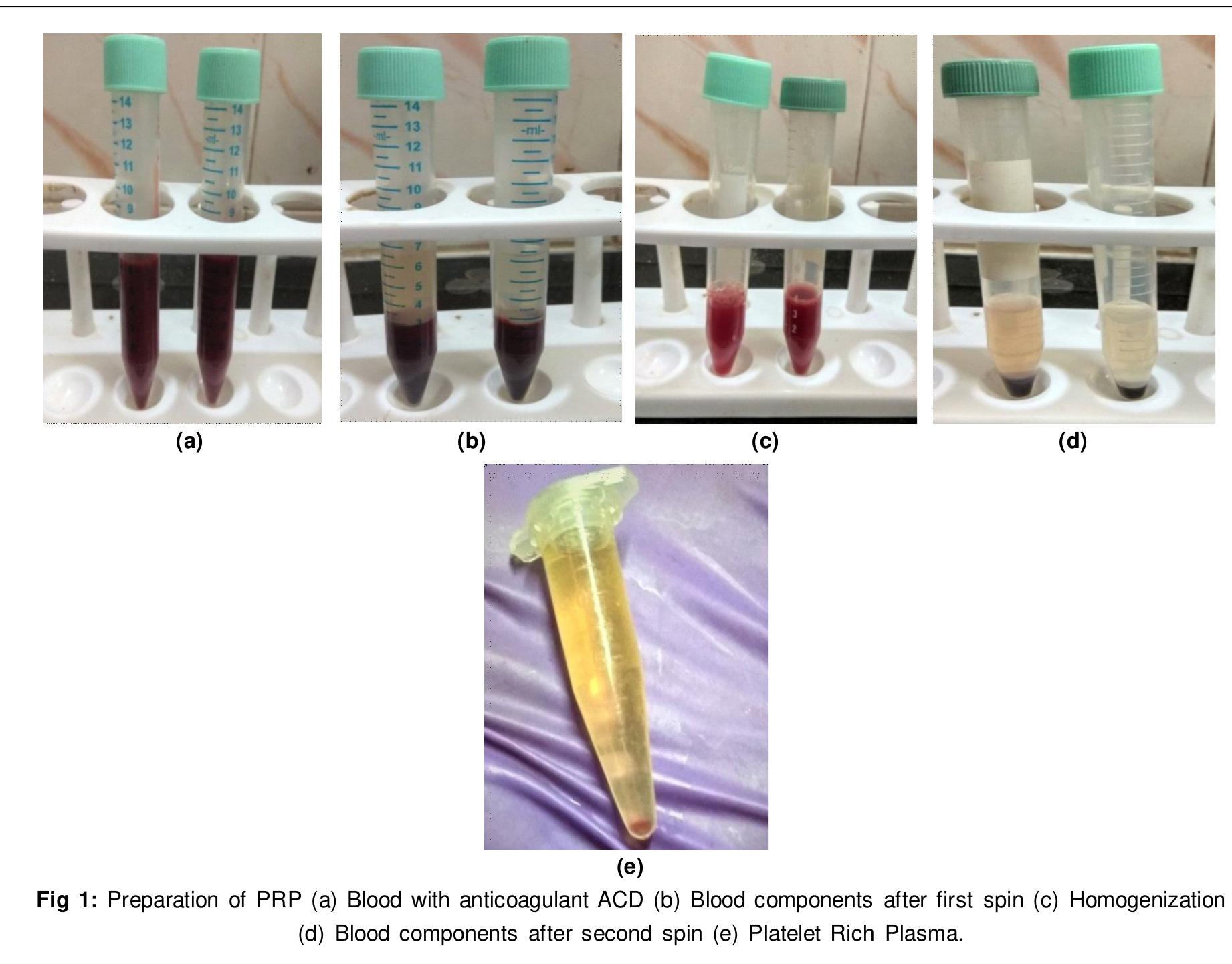 (PDF) Evaluation of Homologous Platelet Rich Plasma (PRP) Drop and ...