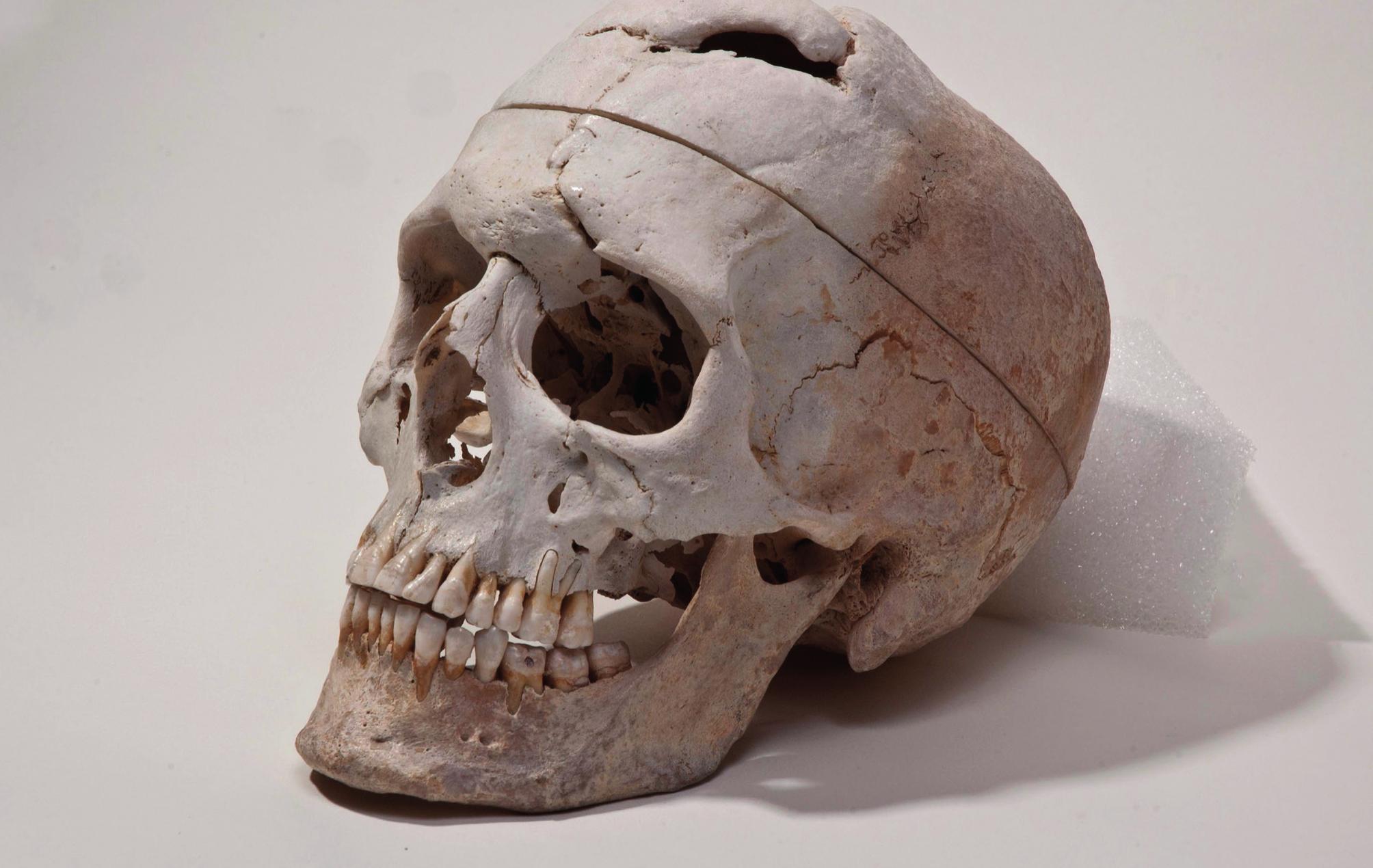 Figure 22.3: Gage’s skull. 