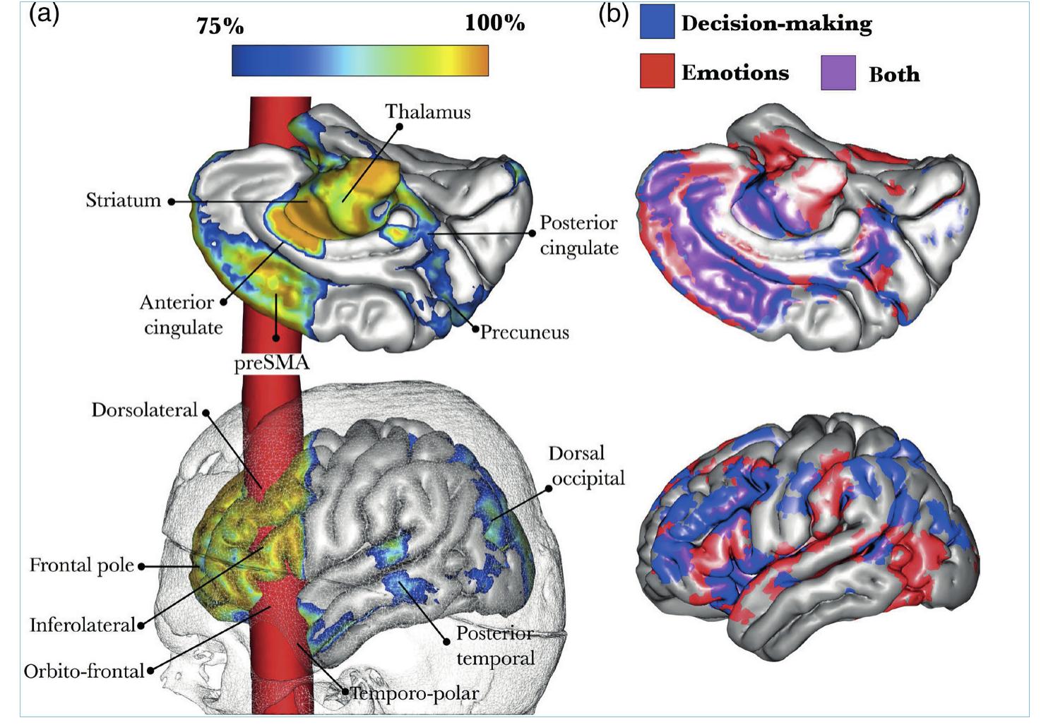 Figure 22.5: Gage’s affected brain areas (Ratiu and Talos 2004).  Y  skull has meant that students have been unable to hold the skull, to run their fingers across the healed fractures, to feel the weight of his injury in their hands. But innovations in rapid prototyping has changed that.  In 2019, Dominic Hall collaborated with colleagues at Harvard Medical School’s anatomy programme to create a three-dimensional- ly printed model for first-year medical students studying general head and neck anatomy, so that students could hold a replica of Gage in their hands as they studied facial musculature, optics nerves and bone structure (see Figure 22.6). This has meant that Gage has been formally re-introduced to the anatomy curricula at Harvard, a shift made possible by new computer technologies. Feeling, touching, tracing Gage’s skull allows for a more haptic interface with bone anatomy and for learning that is important for how students learn to use their own bodies in med- icine (Prentice 2005; Fountain 2010). These new 3D models could be considered a variation of what Rachel Prentice has called “body objects’, which act as ‘teaching tools, diagrams, and models’ (2005: 847). Though Prentice’s body objects ‘inhabit computers’, these 3D print products are only born of computers. They are similarly ‘hybrid objects’ as both ‘med- ical and computational or engineered objects’ (Prentice 2005: 847). 