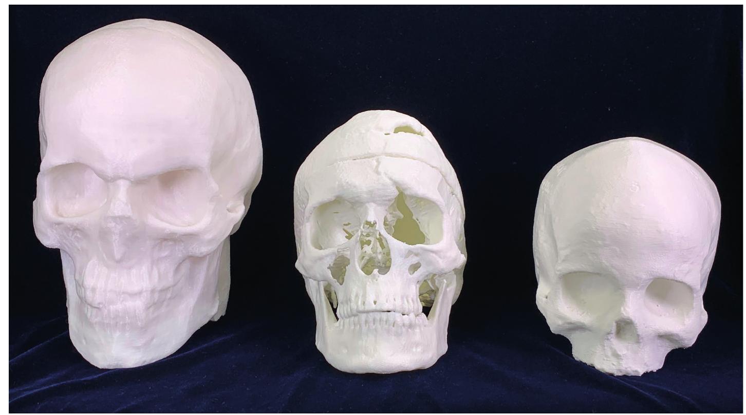 Figure 22.6: Gage’s skull (middle), created with a 3D printer, alongside other 3D-printed skulls from the Warren Anatomical Museum Collection. 