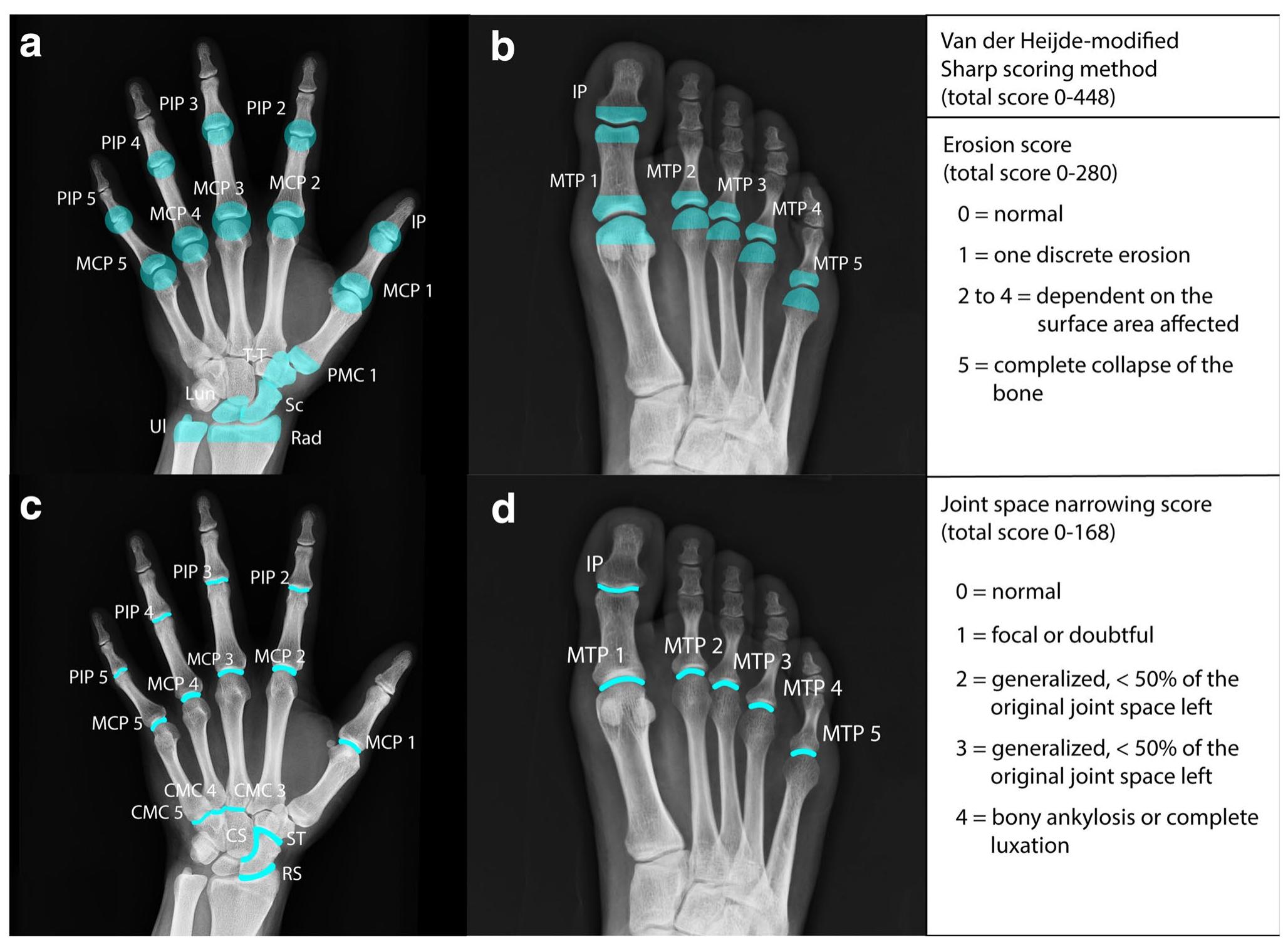 R Score Radiographs (PDF) Radiographic scoring methods in rheumatoid arthritis and ...