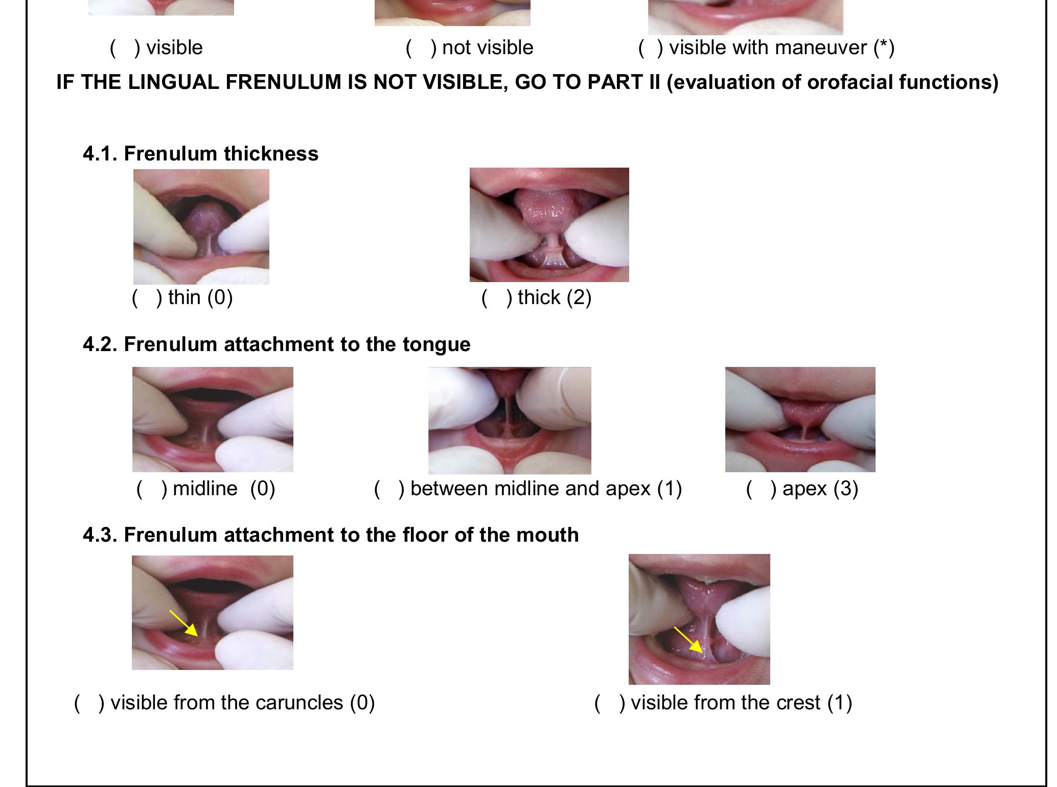 Normal Lingual Frenulum Newborn