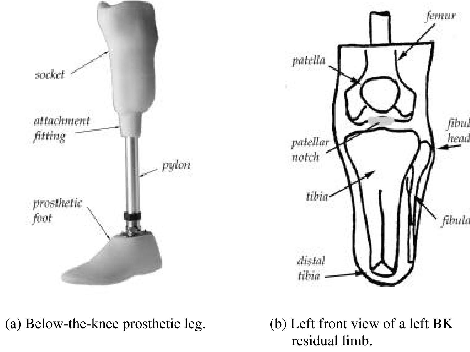 Discomfort when wearing a socket is primarily caused by high pressure on the residual limb tissue, especially in sensitive bony areas, such as the fibular head and the distal end of the amputated tibia. Figure 1(b) shows these landmarks on a residual limb sketch. One way to reduce this pain is to relieve the areas that are sensitive by reducing the stiffness of the socket in these areas. The stiffness necessary for support can be transferred to areas where the tissue is less sensitive and more appropriate to use for support. We propose to provide this selective compliance by locally modifying the geometry of the socket to provide areas of selective compliance and stiffness. We contend that SFF, specifically selective laser sintering, is particularly suited for manufacturing sockets with this geometric complexity. We also contend that the custom nature of the sockets makes SFF an appropriate choice for their manufacture. And we claim that SFF enables the inclusion of an integral pylon fitting, providing superior performance in terms of patient comfort and durability of the socket. 