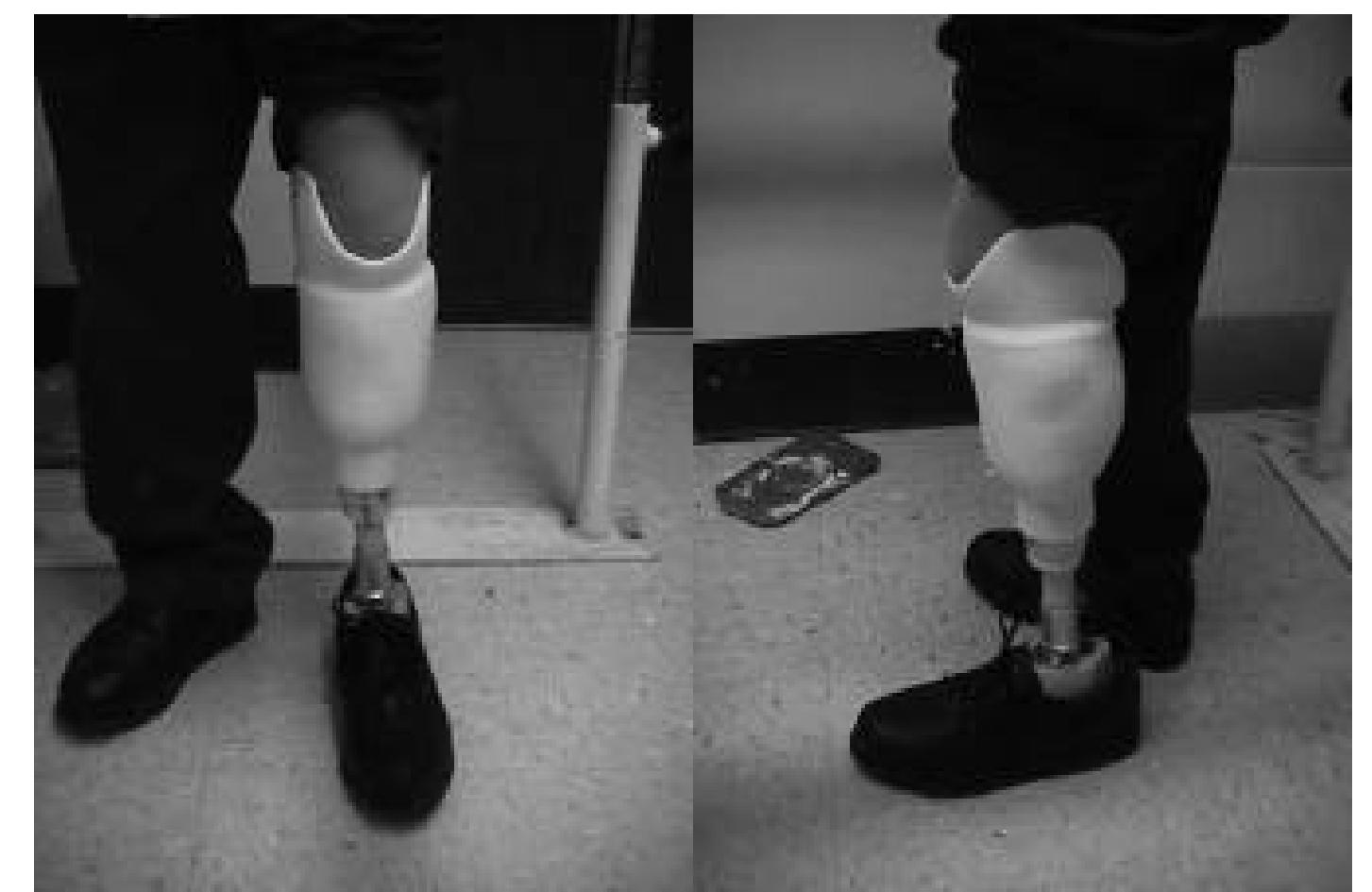 Figure 11. Patient fitting of the prosthesis. 