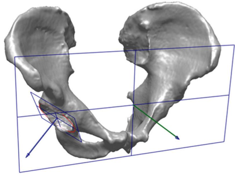 (PDF) The “true” acetabular anteversion angle (AV angle): 2D CT versus ...